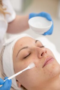 Chemical Peeling in Pune