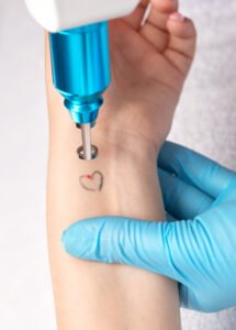Laser Tattoo Removal in Pune