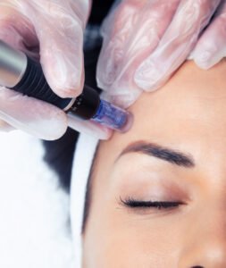 Microneedling in Pune