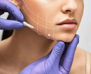 Face Lift / Thread Lift in Pune
