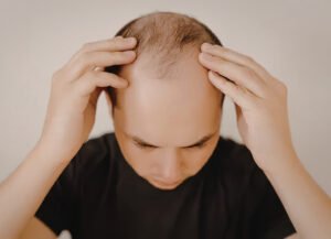 Alopecia & Hair Loss Treatment in Pune