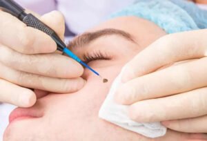 Wart Removal Treatment in Pune