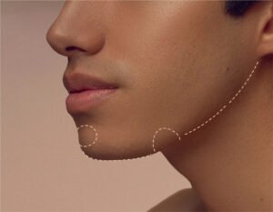 Jawline Contouring Surgery in Pune