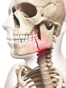 Face & Jaw Fracture Surgery in Pune